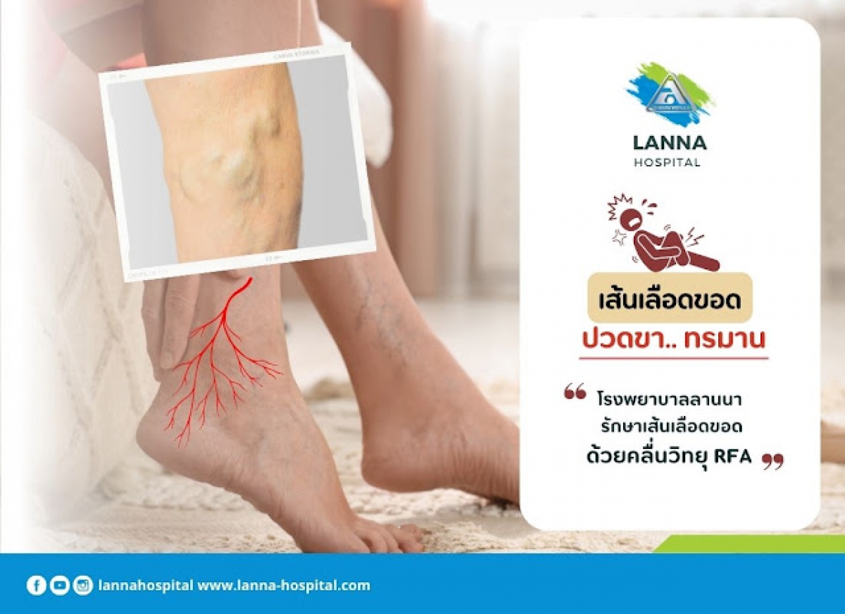 “เส้นเลือดขอด” ปวดขา.. ทรมาน โรงพยาบาลลานนา รักษาเส้นเลือดขอดด้วยคลื่นวิทยุ RFA